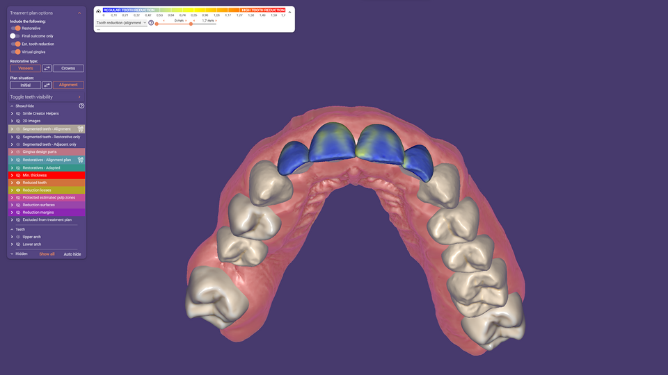 Prothèse Supérieure EXOCAD